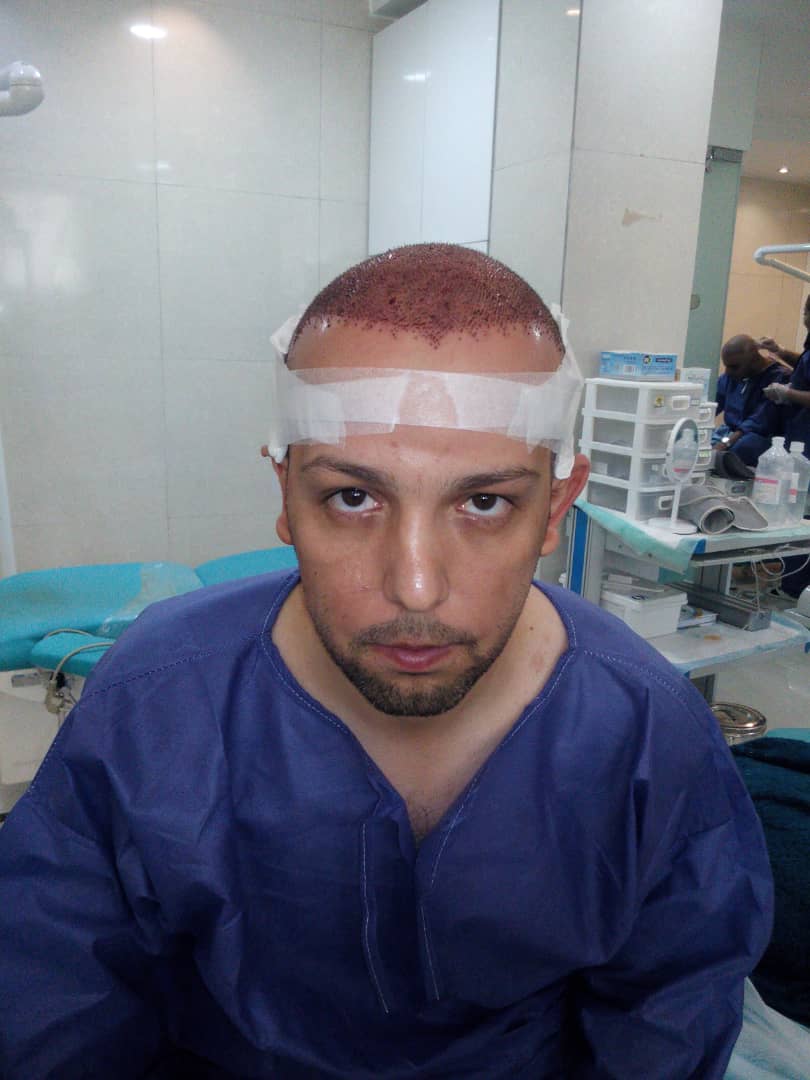 مراحل کاشت مو