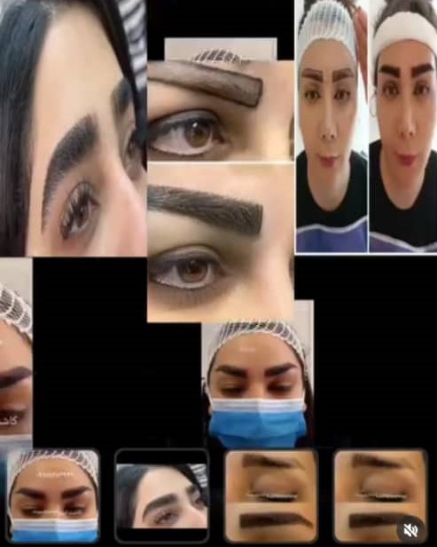 کاشت فولیکول‌های مو